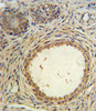 AMH Antibody IHC analysis in formalin fixed and paraffin embedded prostate carcinoma followed by peroxidase conjugation of the secondary antibody and DAB staining.