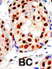 Formalin-fixed and paraffin-embedded human cancer tissue reacted with the primary antibody, which was peroxidase-conjugated to the secondary antibody, followed by DAB staining. BC = breast carcinoma; HC = hepatocarcinoma.