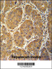MCEE antibody immunohistochemistry analysis in formalin fixed and paraffin embedded human hepatocarcinoma followed by peroxidase conjugation of the secondary antibody and DAB staining.