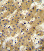 APOF antibody immunohistochemistry analysis in formalin fixed and paraffin embedded human hepatocarcinoma followed by peroxidase conjugation of the secondary antibody and DAB staining.