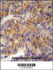 MINPP1 Antibody immunohistochemistry analysis in formalin fixed and paraffin embedded human hepatocarcinoma followed by peroxidase conjugation of the secondary antibody and DAB staining.