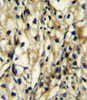 BCAT1 Antibody immunohistochemistry analysis in formalin fixed and paraffin embedded human kidney carcinoma followed by peroxidase conjugation of the secondary antibody and DAB staining.