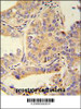 UBA52 antibody immunohistochemistry analysis in formalin fixed and paraffin embedded human prostate carcinoma followed by peroxidase conjugation of the secondary antibody and DAB staining.