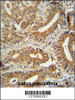 CCDC123 antibody immunohistochemistry analysis in formalin fixed and paraffin embedded human colon carcinoma followed by peroxidase conjugation of the secondary antibody and DAB staining.