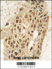 Formalin-fixed and paraffin-embedded human lung carcinoma tissue reacted with Dnmt3a antibody (N-term R46) , which was peroxidase-conjugated to the secondary antibody, followed by DAB staining.