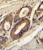 ATP6V0B Antibody immunohistochemistry analysis in formalin fixed and paraffin embedded human prostate carcinoma followed by peroxidase conjugation of the secondary antibody and DAB staining.