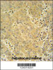 CYP2A7 antibody immunohistochemistry analysis in formalin fixed and paraffin embedded human hepatocarcinoma followed by peroxidase conjugation of the secondary antibody and DAB staining.