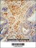 FSTL1 antibody immunohistochemistry analysis in formalin fixed and paraffin embedded human prostate carcinoma followed by peroxidase conjugation of the secondary antibody and DAB staining.