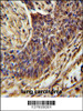 ZSWIM1 Antibody immunohistochemistry analysis in formalin fixed and paraffin embedded human lung carcinoma followed by peroxidase conjugation of the secondary antibody and DAB staining.