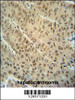 WDR32 antibody immunohistochemistry analysis in formalin fixed and paraffin embedded human hepatocarcinoma followed by peroxidase conjugation of the secondary antibody and DAB staining.