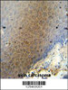 CEP70 antibody immunohistochemistry analysis in formalin fixed and paraffin embedded human skin carcinoma followed by peroxidase conjugation of the secondary antibody and DAB staining.