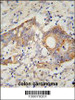 HHLA2 Antibody immunohistochemistry analysis in formalin fixed and paraffin embedded human colon carcinoma followed by peroxidase conjugation of the secondary antibody and DAB staining.