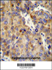 COL18A1 Antibody immunohistochemistry analysis in formalin fixed and paraffin embedded human hepatocarcinoma followed by peroxidase conjugation of the secondary antibody and DAB staining.