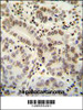 HIST1H2B antibody immunohistochemistry analysis in formalin fixed and paraffin embedded human hepatocarcinoma followed by peroxidase conjugation of the secondary antibody and DAB staining.