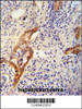 CLPX antibody immunohistochemistry analysis in formalin fixed and paraffin embedded human hepatocarcinoma followed by peroxidase conjugation of the secondary antibody and DAB staining.