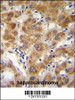 ODF3B antibody immunohistochemistry analysis in formalin fixed and paraffin embedded human hepatocarcinoma followed by peroxidase conjugation of the secondary antibody and DAB staining.