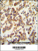 CT173 antibody immunohistochemistry analysis in formalin fixed and paraffin embedded human testis carcinoma followed by peroxidase conjugation of the secondary antibody and DAB staining.