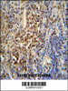 PUS3 antibody immunohistochemistry analysis in formalin fixed and paraffin embedded human lung carcinoma followed by peroxidase conjugation of the secondary antibody and DAB staining.