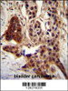 CCDC122 antibody immunohistochemistry analysis in formalin fixed and paraffin embedded human bladder carcinoma followed by peroxidase conjugation of the secondary antibody and DAB staining.