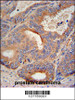 GLB1L2 antibody immunohistochemistry analysis in formalin fixed and paraffin embedded human prostate carcinoma followed by peroxidase conjugation of the secondary antibody and DAB staining.