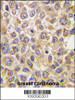 Formalin-fixed and paraffin-embedded human breast carcinoma tissue reacted with PMAT (Slc29a4) Antibody, which was peroxidase-conjugated to the secondary antibody, followed by DAB staining.