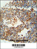 OR9Q1 antibody immunohistochemistry analysis in formalin fixed and paraffin embedded human lung carcinoma followed by peroxidase conjugation of the secondary antibody and DAB staining.