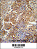 ERCC8 antibody immunohistochemistry analysis in formalin fixed and paraffin embedded human lung carcinoma followed by peroxidase conjugation of the secondary antibody and DAB staining.