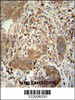 TAGAP antibody immunohistochemistry analysis in formalin fixed and paraffin embedded human lung carcinoma followed by peroxidase conjugation of the secondary antibody and DAB staining.