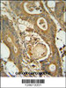 GCNT3 antibody immunohistochemistry analysis in formalin fixed and paraffin embedded human colon carcinoma followed by peroxidase conjugation of the secondary antibody and DAB staining.