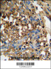 DMP4 antibody immunohistochemistry analysis in formalin fixed and paraffin embedded human breast carcinoma followed by peroxidase conjugation of the secondary antibody and DAB staining.