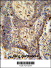 PPRC1 antibody immunohistochemistry analysis in formalin fixed and paraffin embedded human lung carcinoma followed by peroxidase conjugation of the secondary antibody and DAB staining.
