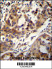 CCDC17 antibody immunohistochemistry analysis in formalin fixed and paraffin embedded human breast carcinoma followed by peroxidase conjugation of the secondary antibody and DAB staining.