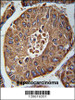 ACN9 Antibody immunohistochemistry analysis in formalin fixed and paraffin embedded human hepatocarcinoma followed by peroxidase conjugation of the secondary antibody and DAB staining.