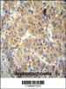 NARS Antibody immunohistochemistry analysis in formalin fixed and paraffin embedded human hepatocarcinoma followed by peroxidase conjugation of the secondary antibody and DAB staining.