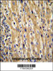 GAL Antibody immunohistochemistry analysis in formalin fixed and paraffin embedded human hepatocarcinoma followed by peroxidase conjugation of the secondary antibody and DAB staining.