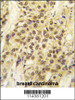 Formalin-fixed and paraffin-embedded human breast carcinoma tissue reacted with HMOF/MYST1 antibody, which was peroxidase-conjugated to the secondary antibody, followed by DAB staining.