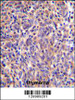 THEMIS Antibody immunohistochemistry analysis in formalin fixed and paraffin embedded human thymoma followed by peroxidase conjugation of the secondary antibody and DAB staining.