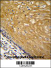 NUDT22 Antibody immunohistochemistry analysis in formalin fixed and paraffin embedded human esophageal carcinoma followed by peroxidase conjugation of the secondary antibody and DAB staining.