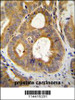 TRPM8 Antibody immunohistochemistry analysis in formalin fixed and paraffin embedded human prostate carcinoma followed by peroxidase conjugation of the secondary antibody and DAB staining.