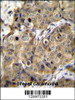 TMEM100 Antibody immunohistochemistry analysis in formalin fixed and paraffin embedded human breast carcinoma followed by peroxidase conjugation of the secondary antibody and DAB staining.