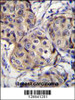 CBLN2 Antibody immunohistochemistry analysis in formalin fixed and paraffin embedded human breast carcinoma followed by peroxidase conjugation of the secondary antibody and DAB staining.