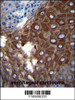 MMP1 Antibody immunohistochemistry analysis in formalin fixed and paraffin embedded human esophageal carcinoma followed by peroxidase conjugation of the secondary antibody and DAB staining.