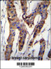 ZBT24 Antibody immunohistochemistry analysis in formalin fixed and paraffin embedded human breast carcinoma followed by peroxidase conjugation of the secondary antibody and DAB staining.