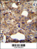 CCNI2 Antibody immunohistochemistry analysis in formalin fixed and paraffin embedded human breast carcinoma followed by peroxidase conjugation of the secondary antibody and DAB staining.