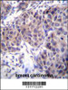 DVL3 Antibody immunohistochemistry analysis in formalin fixed and paraffin embedded human breast carcinoma followed by peroxidase conjugation of the secondary antibody and DAB staining.