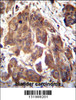 GLMN Antibody immunohistochemistry analysis in formalin fixed and paraffin embedded human bladder carcinoma followed by peroxidase conjugation of the secondary antibody and DAB staining.