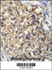 KLHL35 Antibody immunohistochemistry analysis in formalin fixed and paraffin embedded human breast carcinoma followed by peroxidase conjugation of the secondary antibody and DAB staining.