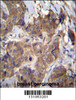 ATP6V1B1 Antibody immunohistochemistry analysis in formalin fixed and paraffin embedded human breast carcinoma followed by peroxidase conjugation of the secondary antibody and DAB staining.