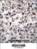 SFRS7 Antibody immunohistochemistry analysis in formalin fixed and paraffin embedded human hepatocarcinoma tissue followed by peroxidase conjugation of the secondary antibody and DAB staining.