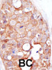 Formalin-fixed and paraffin-embedded human cancer tissue reacted with the primary antibody, which was peroxidase-conjugated to the secondary antibody, followed by DAB staining. BC = breast carcinoma; HC = hepatocarcinoma.